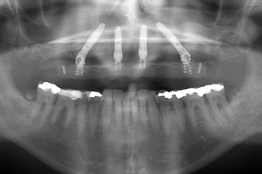 Reconstruction fixe sur 4 implants au maxillaire supérieur