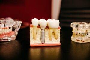 Conseils pour une récupération en douceur à la suite d’implants dentaires