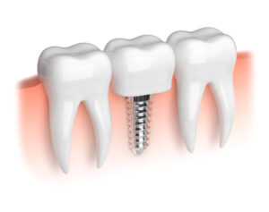 Comment les implants dentaires aident-ils à prévenir la perte osseuse ?