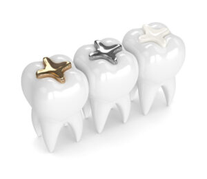 Choses importantes à savoir sur les obturations dentaires