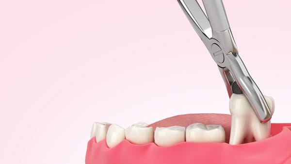 Que Manger Apres Extraction De Dents Que Manger Après Une Extraction De Dents De Sagesse? 23 Extraction de dents : pourquoi cela peut être nécessaire